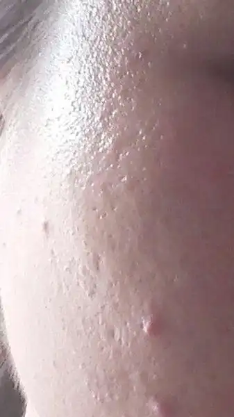 痘痘肌,油性皮肤,脸颊两侧毛孔很大,皮肤坑坑洼洼,很烦恼!