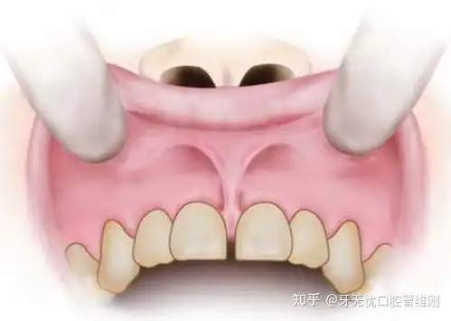 关于预防性矫正,家中有12岁以下的孩子家长们请注意了!——牙无忧口腔