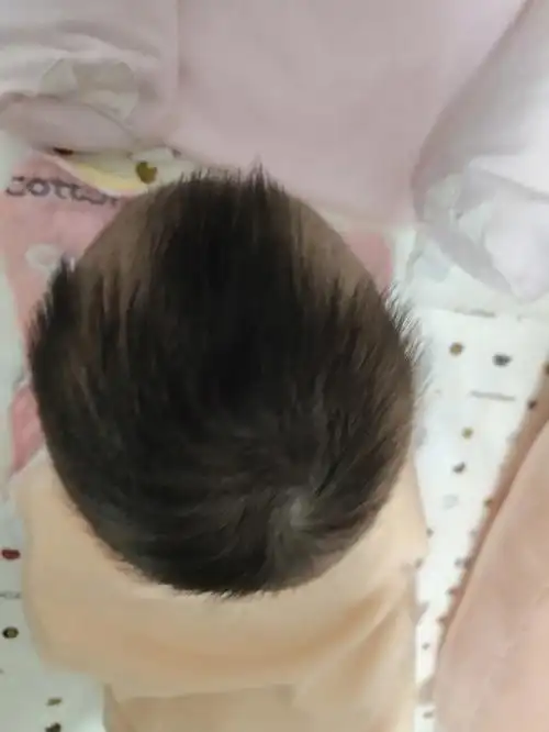 快三个月的宝宝这样的头型还有救嘛