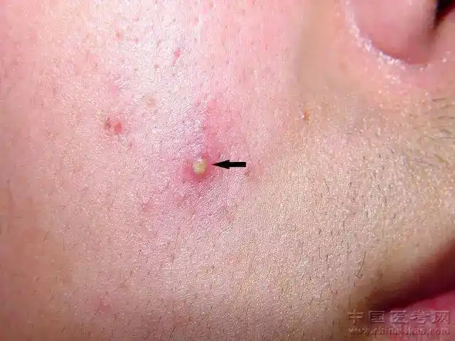 史上最全常见皮肤病图谱