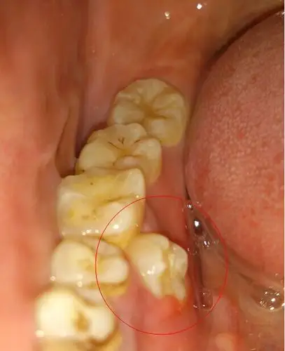 牙龈旁边长出一个向舌头的牙齿,这叫什么牙?需要拔掉吗?