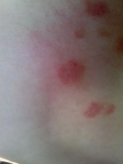 异位性皮炎的图片