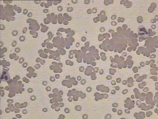 引起红细胞凝集的原因有很多,如冷凝集素,自身抗体,低白蛋白血症等