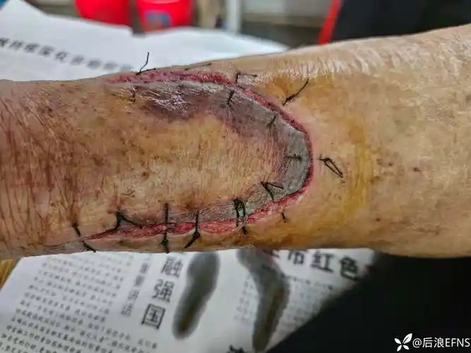 病人伤口现在有些发黑该如何处理好