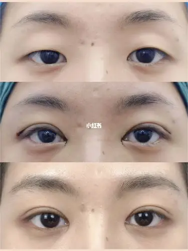 右眼上睑下垂左眼单眼皮 术后2月很好看_单眼皮_双眼皮_双眼皮手术_全