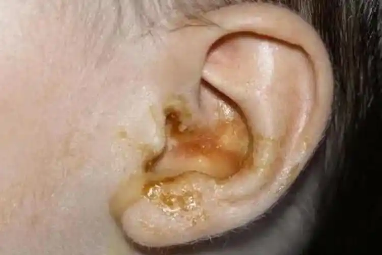 外耳道急性湿疹图