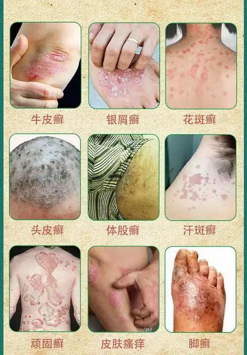 复方黄柏癣祛搽剂初肤堂同款癖祛喷剂牛皮鲜癣屑银