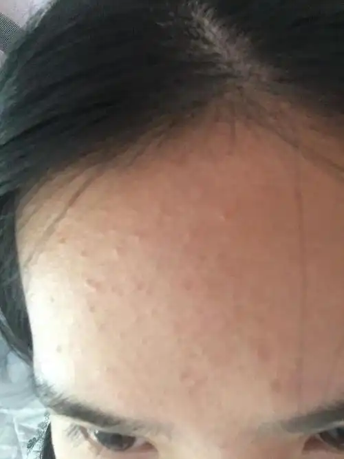 救命啊最近脸上疯狂长闭口