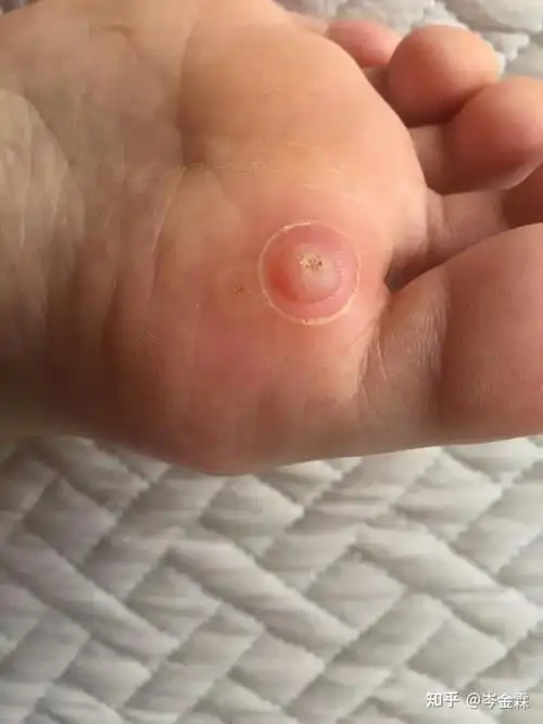 鸡眼该怎么治疗预防鸡眼需要注意什么