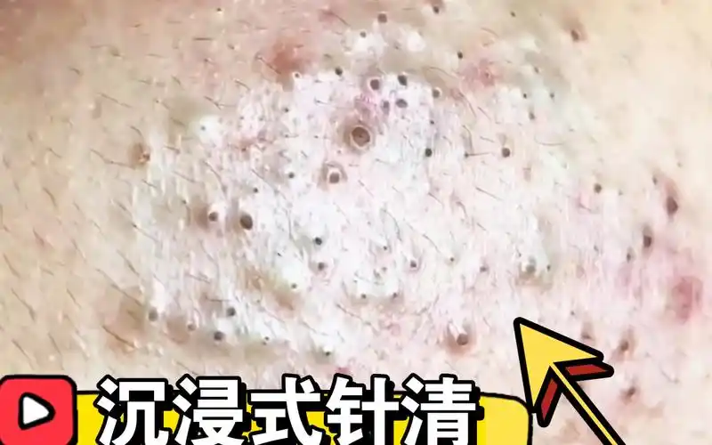 沉浸式针清【解压助眠】针清|面部护理|深层清洁|黑头粉刺|毛孔粗大