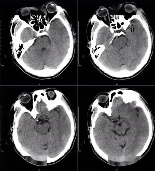 67超急性期大面积脑梗死ct平扫表现