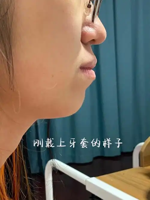 浅记录下牙套两年侧颜的变化无美颜无滤镜