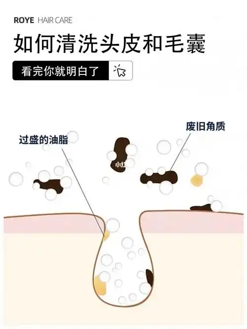 如何清洁头皮和毛囊71简易版