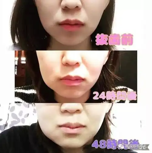 吐血再可爱的妹子拔完智齿也是一秒肿成歪脸姆明啊