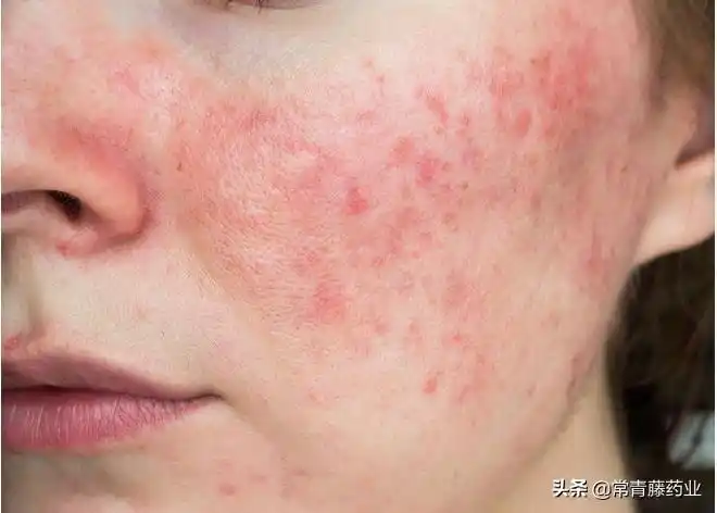 脸蛋容易泛红,可能不是羞涩,皮肤科医生:真相可能是玫瑰痤疮