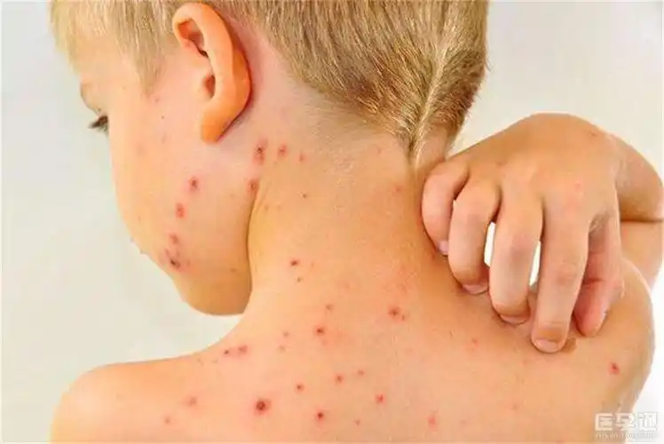 自家宝宝疹子的症状图片分享依图比对准确又快速