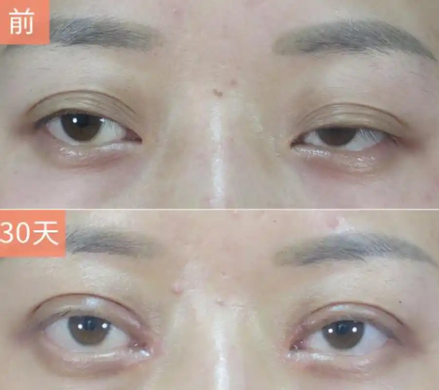上眼睑下垂矫正