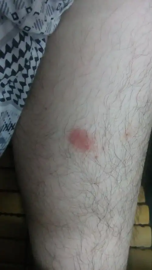 问:小腿上多了一块斑,今天有点疼