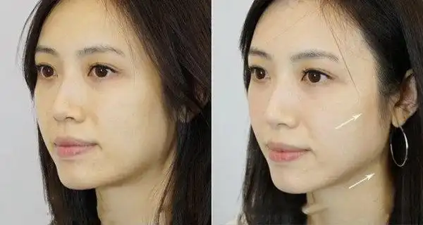 新一代的thermage flx热玛吉神器,是怎么让皮肤更年轻紧致的?