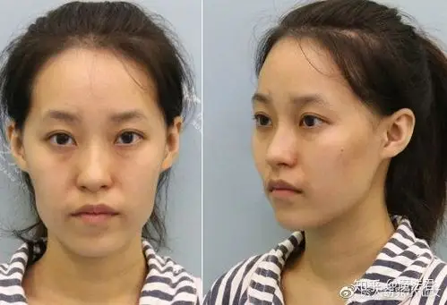 自体脂肪填充面部轮廓术前术后效果对比