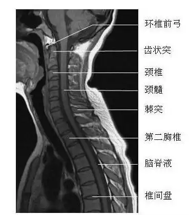 脊柱mri解剖图片