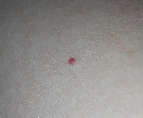 皮肤是有几个小红血点.请问这是怎么了?不痛不痒.