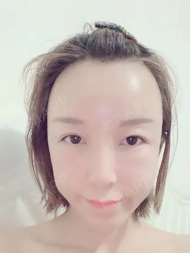 自体脂肪填充额头