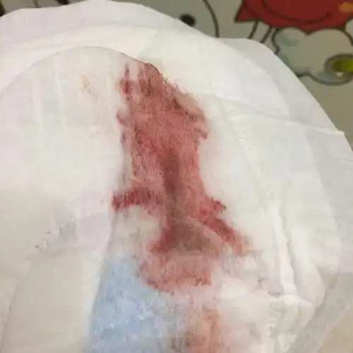 天会有着床出血的症状,现在在月经期间出血首先考虑是月经,并没有怀孕