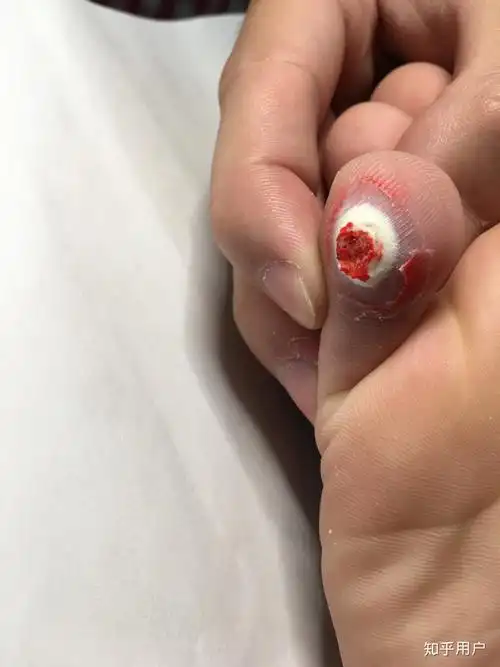 鸡眼怎么彻底挖出? - 知乎