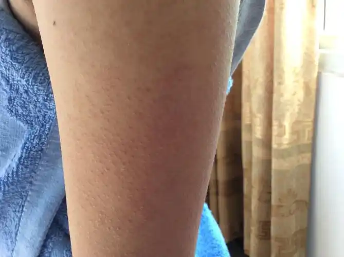 我媳妇手臂上长了不知道的是什么痘痘,该怎么治?