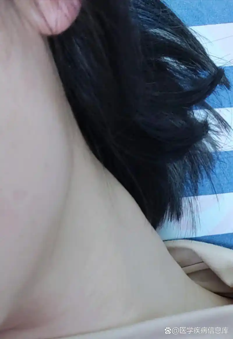 颈部淋巴结肿大