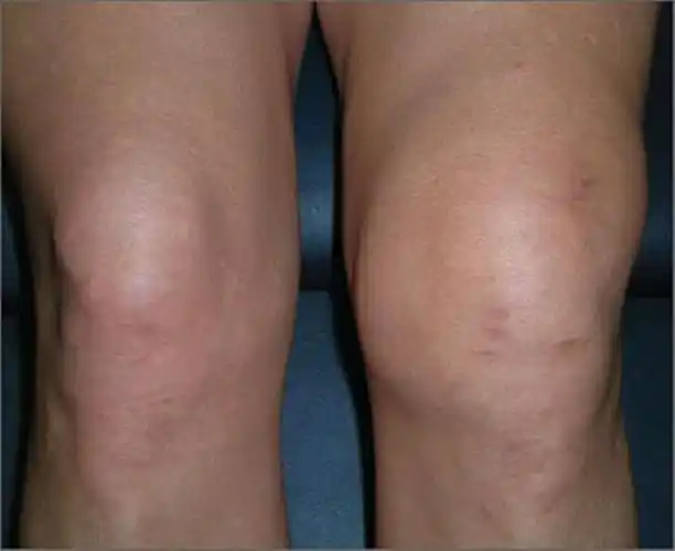 膝关节积液但不疼还能运动吗该不该抽积液