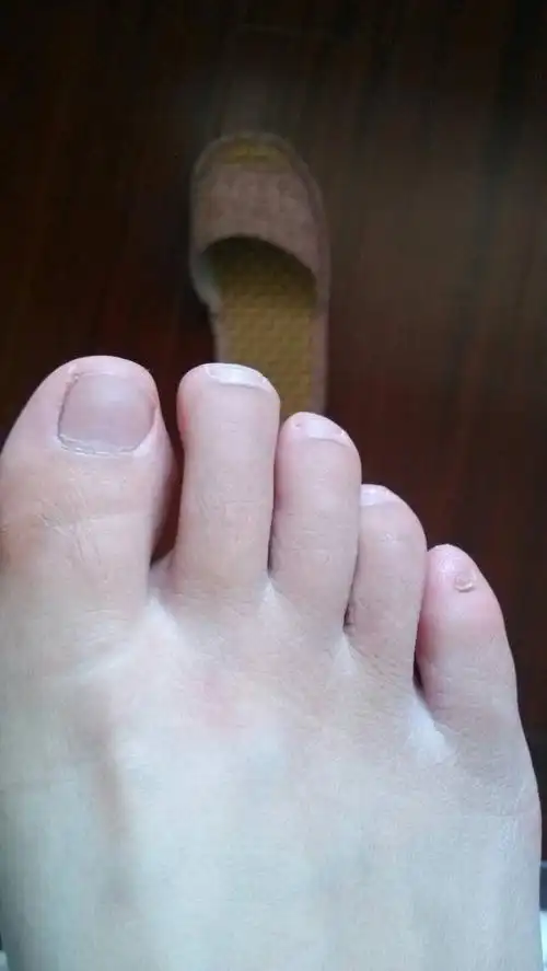 为什么我的小脚趾甲这么小?我是遗传我妈的,她是蒙古族.