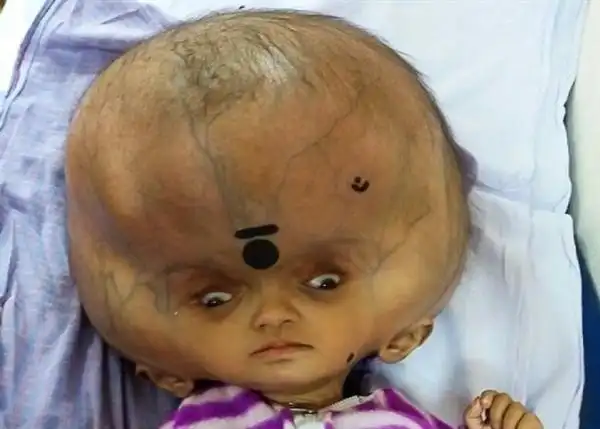 男孩患病头部肿胀如西瓜:治疗后头围缩26厘米