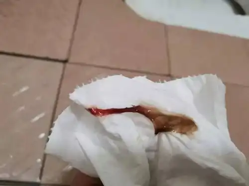 请问带血白带是怎么回事呀