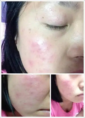 前两天朋友都跟我说是季节或者化妆品过敏,我的皮肤不是过敏性皮肤