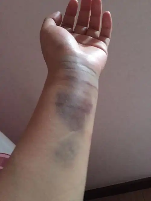 怀孕八个月,手韧带受伤,要怎么才好得快点!一点力也用不上!该怎么办!