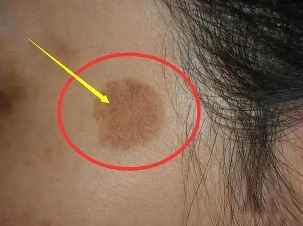 红霉素软膏能够去除老人斑吗?看完涨知识了