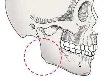 下颌角切多了怎么办?还能复原吗?用什么修复?