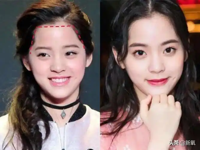 发际线破相(额头破了影响运气)