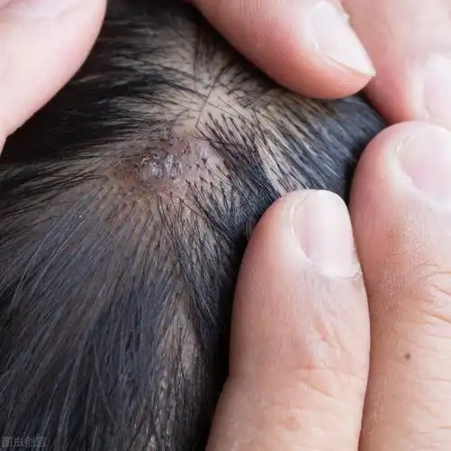 头皮皮炎的鉴别图片 脂溢性皮炎的结痂图片 - 花颜茶语