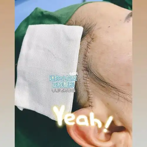 「今日分享」#迷你小拉皮 #拉皮  #拉皮手术  #小切口拉皮效果超级