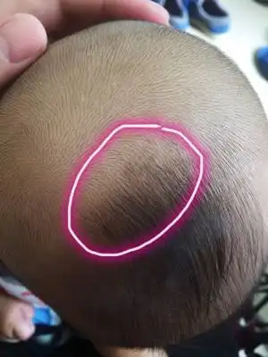 宝宝三个月12天,突然发现头上长了这种黄色的痂,请