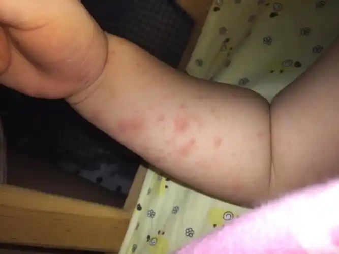 宝宝六个月前吃蛋黄过敏,现在一岁多点了,一个星期前又吃了点蛋黄