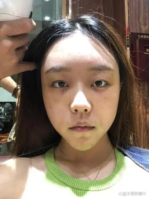 眼窝凹陷是好事还是坏事,一定要做脂肪填充吗?可以做双眼皮吗?