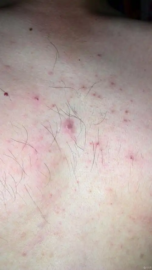 胸口上红点不痛不痒,已经有半个月之久
