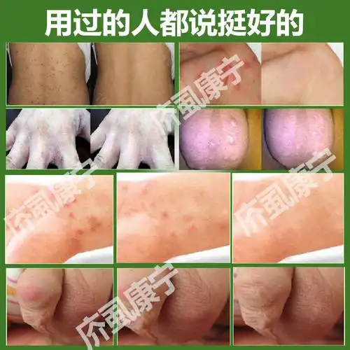 疥虱康宁特效止痒膏去庎螨霜硫磺软膏虫卵阴囊结节灵疥舒宁一扫光