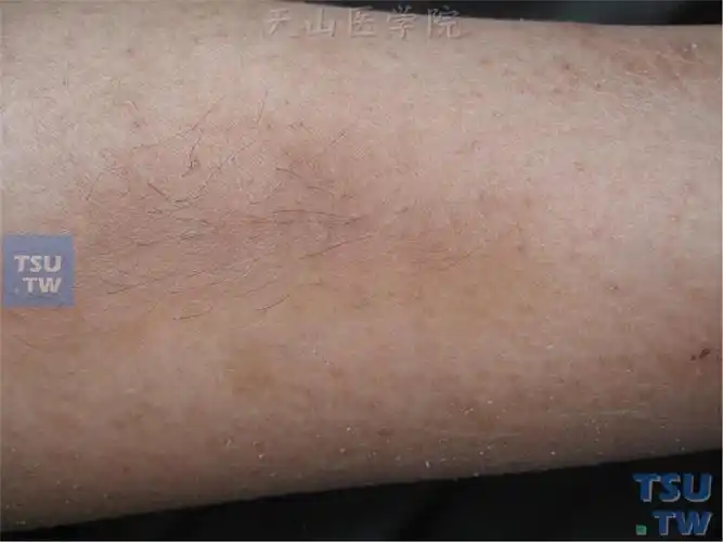 人为性脂膜炎factitialpanniculitis症状表现