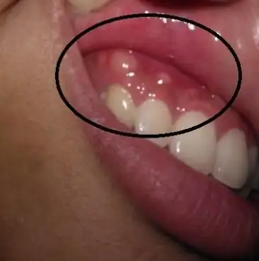 牙肉长东西了