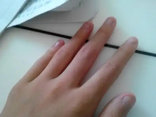 我爱咬指甲,指甲长成这样了,怎么办?